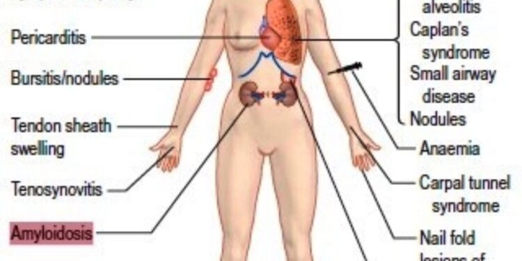 FMF (Akdeniz Ateşi) ‘de Beslenme